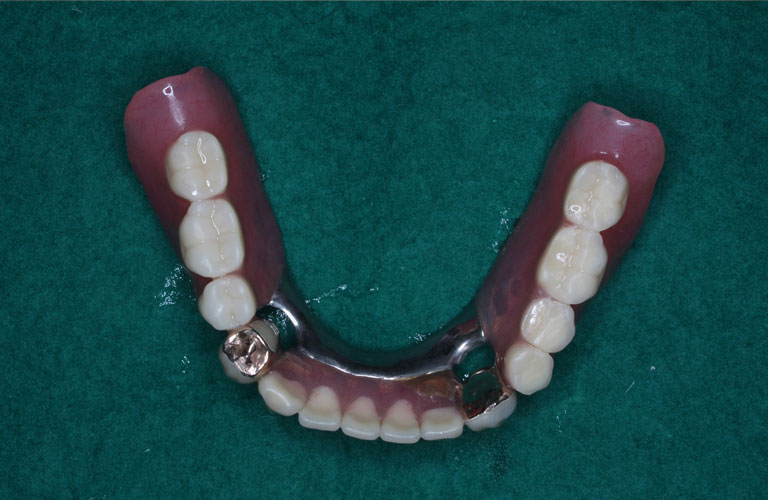 連結コーヌス義歯