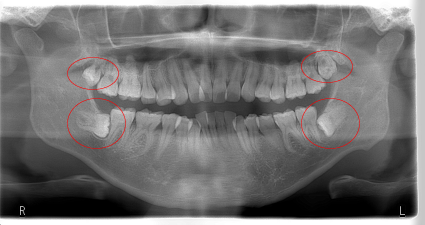久喜市の歯医者いしはた歯科クリニックでは1度に2〜4本の抜歯も承ります