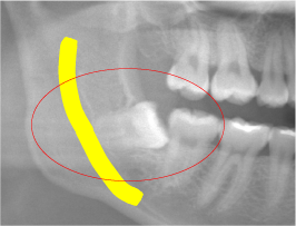 レントゲン画像により親知らずが神経と重なっているのが確認できる｜久喜市の歯医者いしはた歯科クリニック