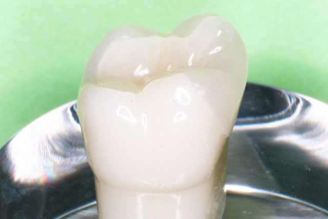 久喜市のいしはた歯科クリニック　セラミックインレー