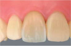 審美的な歯の治療 メタルボンド 久喜市のいしはた歯科クリニック