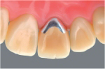 審美的な歯の治療 メタルボンド裏側 久喜市のいしはた歯科クリニック