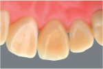 審美的な歯の治療 オールセラミッククラウン裏側 久喜市のいしはた歯科クリニック
