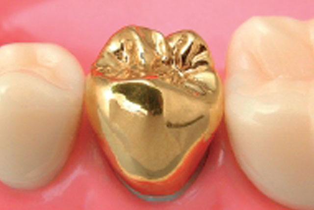 久喜市のいしはた歯科クリニック　ゴールドクラウン