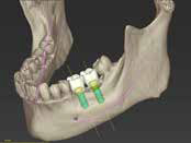 ガイドサージェリーのイメージ図｜久喜の歯医者 いしはた歯科クリニック