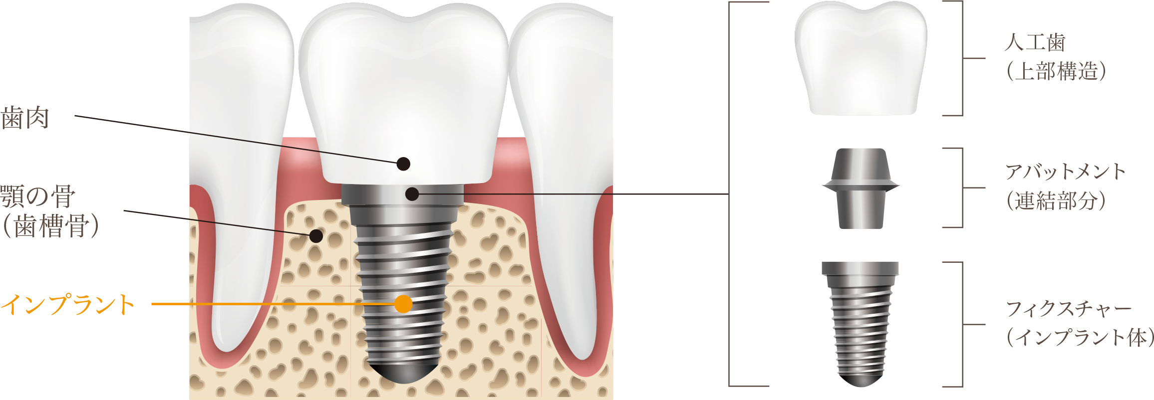 インプラントは天然の歯に近い構造を持つ
