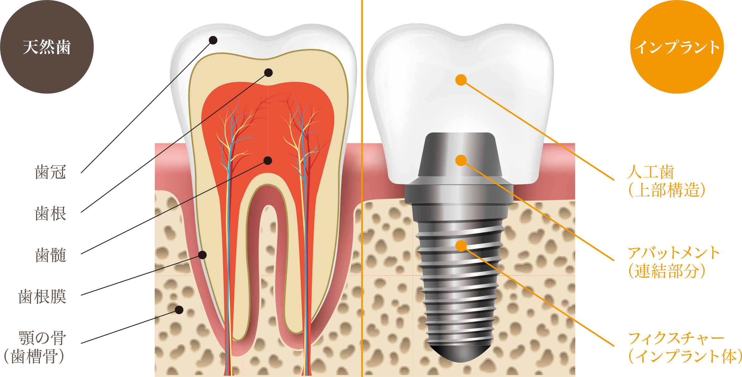 インプラントと天然の歯の比較画像｜久喜の歯医者 いしはた歯科クリニック