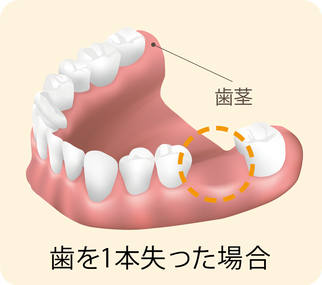 歯を1本失った場合｜久喜の歯医者 いしはた歯科クリニック