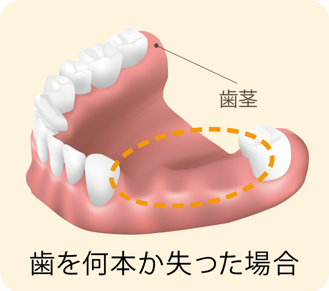 歯を何本か失った場合｜久喜の歯医者 いしはた歯科クリニック
