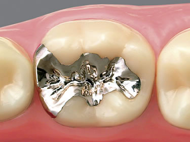久喜市のいしはた歯科クリニック　メタルインレー