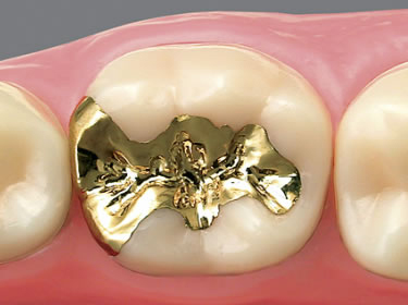 久喜市のいしはた歯科クリニック　ゴールドインレー
