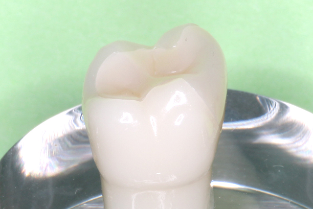 久喜市のいしはた歯科クリニック　ハイブリッドインレー