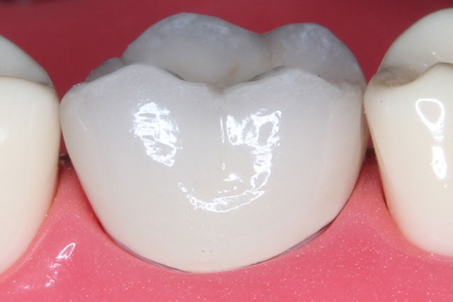 久喜市のいしはた歯科クリニック　メタルボンドクラウン