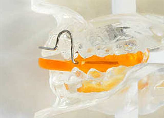 矯正の装置～バイオネーター（機能的矯正装置）～ 久喜市の歯医者いしはた歯科クリニック