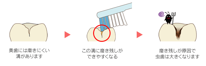 シーラントをする前の歯の様子 久喜市のいしはた歯科クリニック