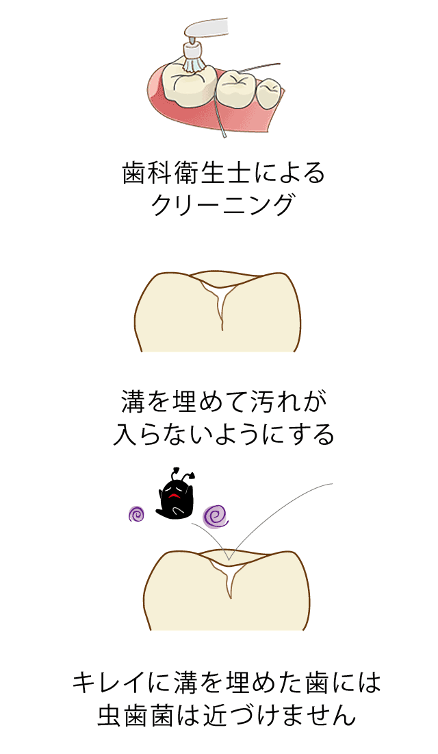 シーラントをした歯の様子 久喜市のいしはた歯科クリニック