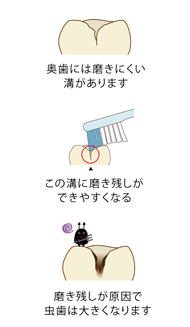 シーラントをする前の歯の様子 久喜市のいしはた歯科クリニック