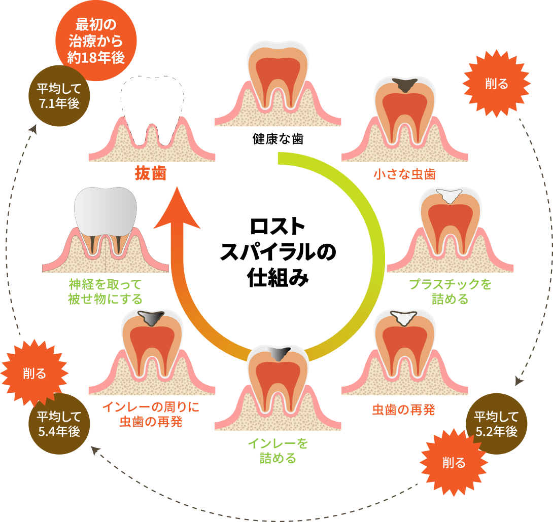 歯が失われるーロストスパイラルの仕組み