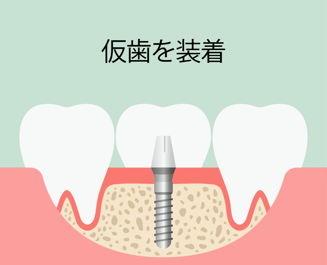 インプラント即時埋入術：手順5 仮歯を装着