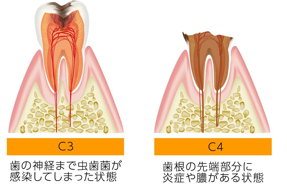根幹治療を必要とする歯の状態