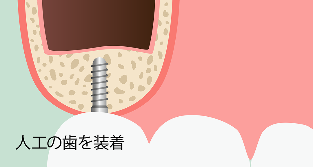 サイナスリフト術 手順9:人工の歯を装着