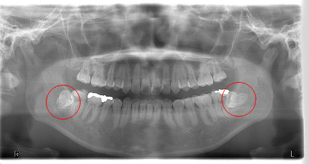 いしはた歯科クリニックの親知らずの抜歯前の画像検査
