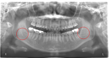 いしはた歯科クリニックの親知らずの抜歯一年後の画像検査