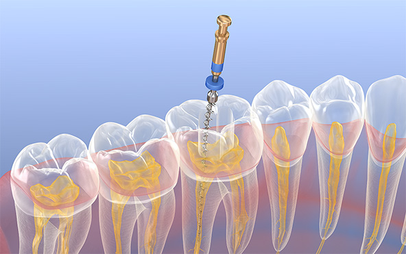 根管治療｜久喜市の歯医者いしはた歯科クリニック